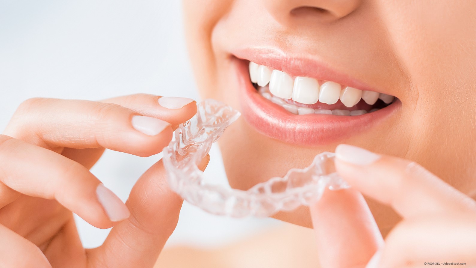 Unsichtbare Zahnregulierung mit Alignern (z.B. Invisalign)