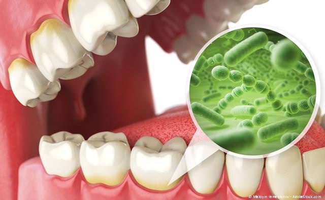 Parodontitis-Behandlung bei Zahnlockerungen und gegen Zahnverlust