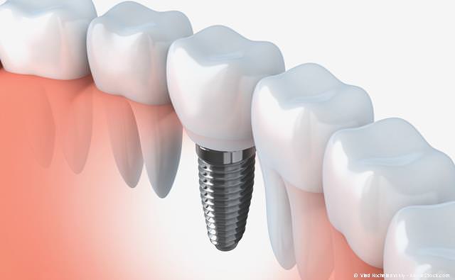 Zahnimplantate - so fest wie eigene Zähne