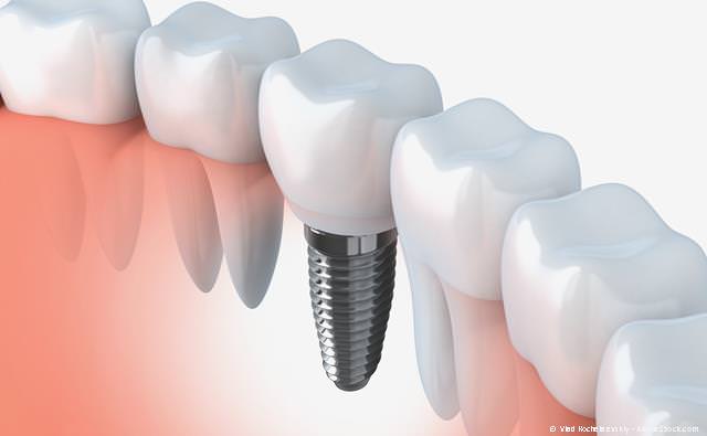 Zahnimplantate: So fest wie eigene Zähne