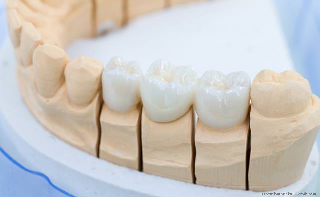 Zahnersatz: Zahnkronen, Zahnbrücken, Teilprothesen und Vollprothesen